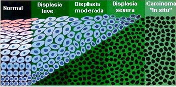 Classificações dos carcinomas intracervicais (NICs)