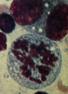 Endomitose multipolar em células de Hodgkin.